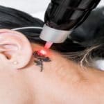 How skin tone affects laser tattoo removal