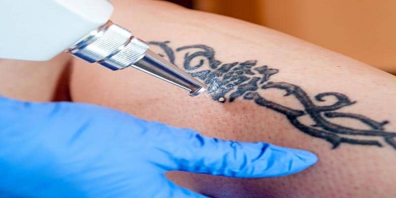 How skin tone affects laser tattoo removal